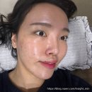 약초길 | 강남 한의원 약초침 율각테라피 여드름 흉터 색소침착 통증 효과 후기 (내돈내산)