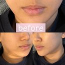 모찌네 살롱 | 관악피부관리 모찌살롱 예스필로 속건조,좁쌀까지 잡은 다운타임 없는 필링 후기