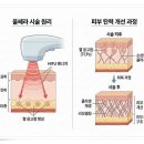 유엔아이퍼스트 | 광교울쎄라 효과와 부작용 확인하세요