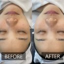멜라닌 모공관리 일산서구대화동피부관리샵 알엔뷰티랩&amp;스칼프디자인센터 일산