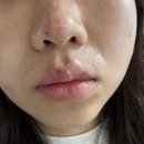 (주)굿팜 | [피부관리] 얼굴 전체 점제거 후기1