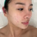 용호예가아파트(2차)경로당 | 용호동 에스테틱 리즈더라인 플라이저 플라즈마 후기