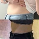 대일목욕탕 | 복부 옆구리 람스 한달차 흉터 후관리 후기