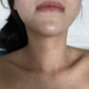 편평사마귀 제거 후기 - 편평사마귀 제거 2주 후기 “강한미의원“