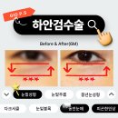 눈밑성형, 나같은 케이스는 하안검수술전후 어떻게 달라질까 이미지