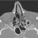 비중격만곡 (Nasal Septal Deviation) 이미지