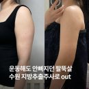 (주)수원제일공업사 | 수원 다이어트 병원 팔뚝 지방추출주사 당일 멍 붓기 통증 가격 후기