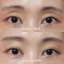 우일여성사우나 | 눈두덩이지방이식 30대 초반 전후 가격·부작용·후기까지