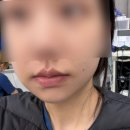 플러스신경과의원 | 전문 치과만큼 안아프게 잘 뽑는 치과 (+비용정보O) | 양쪽 매복사랑니 발치 | 실밥제거 O | 발치후기 🦷