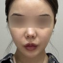 지지피 | 울쎄라피 프라임 효과, 시술 전후 변화가 궁금하다면?(ft. 시술 후기)