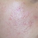 무등산한의원 | [내돈내산] 광주 해율한의원 새살침 흉터치료 강추후기