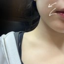 청담동 피부과 후기: 미간보톡스, 입꼬리 보톡스, 1인병원