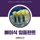 청량리임플란트추천 임플란트 성공의 핵심은 잇몸뼈