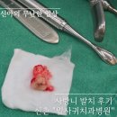 삐뚤한이바르게치과교정과치과의원 | 사랑니 전문 치과 신촌 잎사귀치과병원 가격 통증 부작용 실비 처리 후기