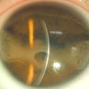 이차돌창원반지점 | 각막변성증 (Corneal degeneration) (2) - 나이와 관련없는 변성