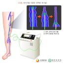 하지정맥류 Varicose Vein, Spider Vein 이미지