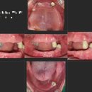 세움치과의원 | 아래틀니가 불편한 이유, 임플란트가 답입니다 | 천안 두정서울비디치과