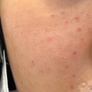 에스에이치비지 | 💉리쥬란힐러 손주사 후기💉