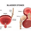 삼육수산 | 응급실 가는 고통 요로결석!! 증상 원인 그리고 후기