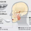 노년기 빠진 치아 방치하면 치매 위험이 높아진다. 이미지