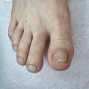 포쉬네일 풀리메디 안산점 | 시흥내성발톱 두꺼운발톱 관리 후기 포쉬네일 동성제약 풀리메디 족보있는그녀들 안산점