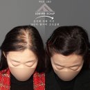 서울헤어명작 | [홍대 여성탈모] 청주에서 9회 방문한 50대 여성 고객 두피문신 실제 사례