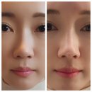 하이코코 | 대구 코 실리프팅 트렌디코 하이코 내돈내산 후기