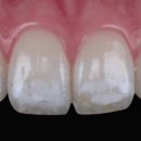 단계반점 이미지