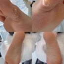 슈필라움 | [ 당진 발각질제거, 무좀전문 관리샵 추천 ] - 레푸스&amp;슈필라움 네일 (발각질 제거 솔직 후기)