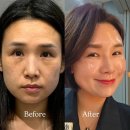 ICD 인셀덤 화장품 놀라운 효과｜Before After 피부 변화 실제 후기