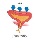 복압성 요실금[Stress urinary incontinence]신장비뇨기질환, 여성질환 이미지