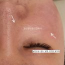 [홍조피부관리][ 주사피부염관리] 시술없이 순수한 피부관리만으로 1회만에 얼마나 달라질 수 있을까?