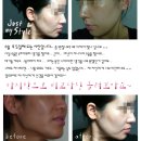 30대 아줌마의 귀뒤사각턱 수술후기 5일째 입니다. 힘내세요~ 이미지