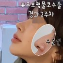 하이코코이비인후과의원 | 무보형물코수술 필러·하이코 후 코끝 처짐 개선 방법