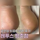 W 에이스타워 | 안양발각질 뒤꿈치 관리로 아기발 됨 레푸스평촌점 후기