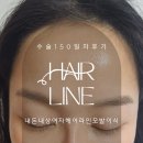 헤어콤파스 | 여자헤어라인모발이식후기_150일차ft내돈내산5개월육모일기