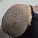 토닥토닥약국 | 아기 두피 선천성 피지선모반 머리 수술 이야기