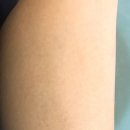 <라파엘 외과>하지 정맥류 경화요법, 성남 분당 하지 정맥류, 경화 요법 후기, 혈관경화 요법