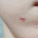 지안메디케어 | 단백질재생케어 좁쌀여드름관리 셀럽메디스파 우장산점에서 하고왔어요~!