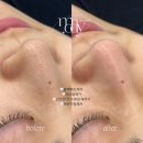 더 스윙블랙 천호점 | 천호 블랙헤드제거 잘하는곳 세라링 후기 많은 이유