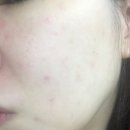 뾰루지 케어에 좋은 여드름 패치, 티안나 스펀지 패치 사용 후기