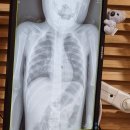 엄지어린이집 | 만1세 아기 어린이집 입소 후 콧물 결국 폐렴 엑스레이 진단