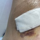 멍이날개 | 손다한증 수술 한달차 후기, 통증 실밥 외래 보상성 여부