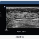 맑은유영상의학과의원 | <분당유방암클리닉>고위험병변에 대해 자세히 알아보자