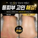 채움;결 | 광주 진월동 등드름관리 잘하는곳 채움결뷰티 등피부 개선 후기