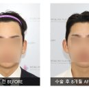 모앤라인성형외과의원 네이버블로그