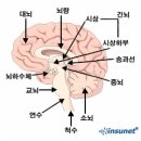 뇌동맥류(뇌동맥꽈리) 이미지