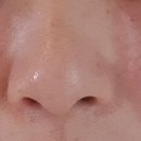 하이린의원 리쥬란 맞은 후기