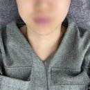 소프라노의원 | 소프라노 티타늄 리프팅 통증 후기 효과 솔직 리뷰