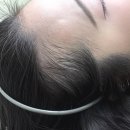 라인1차 | [일산 헤어라인 시술]승무원 헤어라인 전문 '아이브' 1차 시술 솔직 후기